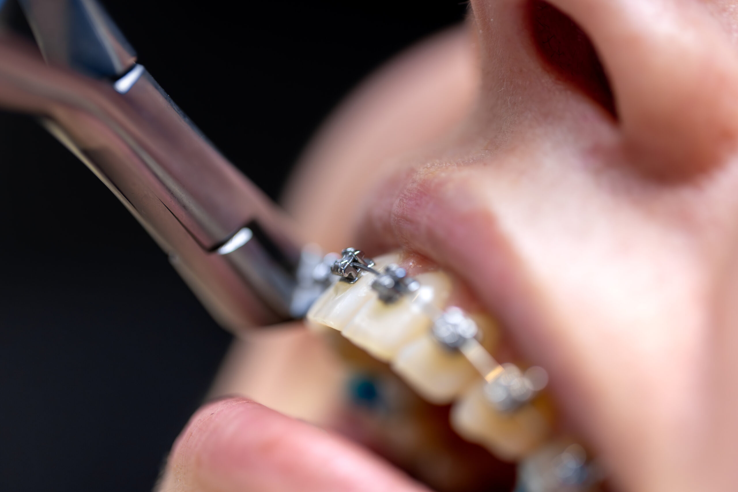 Металеві брекети в Києві — Solovei Dental Clinic