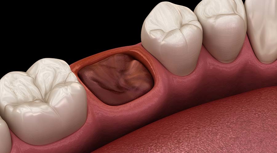 Видалення кореня зуба в Києві — Solovei Dental Clinic