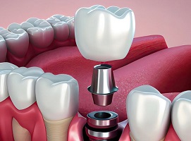 Які протипоказання до імплантації зубів існують — Solovei Dental Clinic
